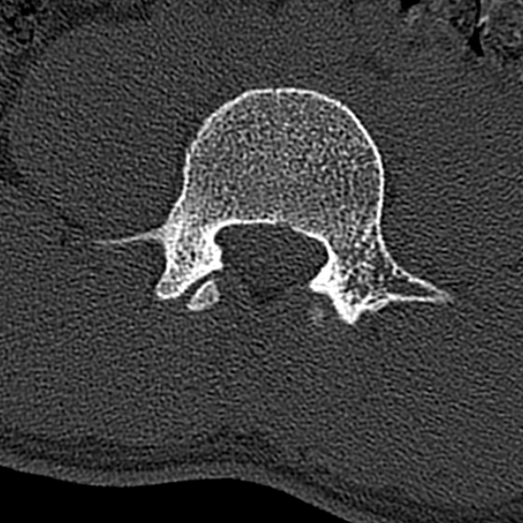 Burst fracture (Radiopaedia 53373-59357 Axial bone window 44).jpg