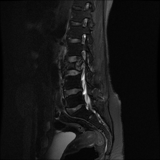 File:Burst fracture - lumbar spine (Radiopaedia 72877-83541 Sagittal STIR 7).jpg