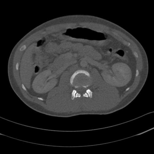 Burst fracture with cauda equina syndrome (Radiopaedia 25701-25867 Axial bone window 25).jpg