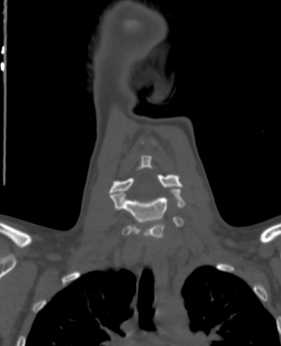 File:Butterfly vertebra (Radiopaedia 77903-90209 Coronal bone window 25).jpg