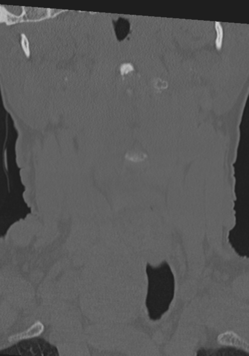 C2 fracture with vertebral artery dissection (Radiopaedia 37378-39199 Coronal bone window 6).png