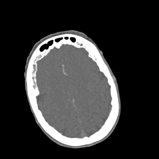C2 fracture with vertebral artery dissection (Radiopaedia 37378-39200 A 279).png