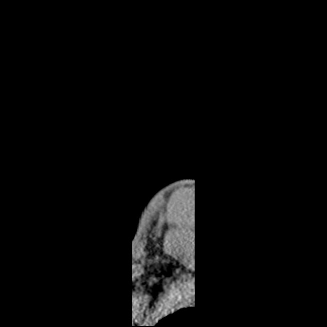 C5 facet fracture (Radiopaedia 58374-65499 D 1).jpg