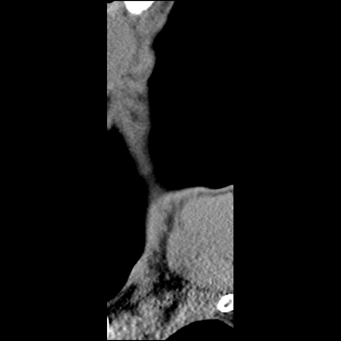 C5 facet fracture (Radiopaedia 58374-65499 D 70).jpg