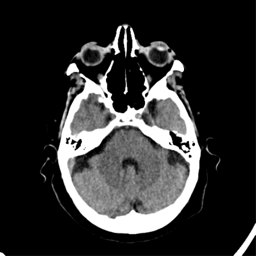 File:CNS Lymphoma (Radiopaedia 44198-47794 Axial non-contrast 11).png
