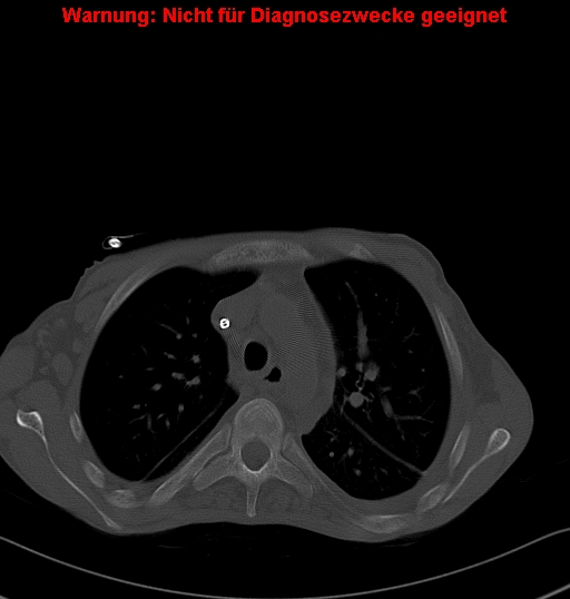 File:Calcific constrictive pericarditis (Radiopaedia 24701-24967 Axial bone window 1).jpg