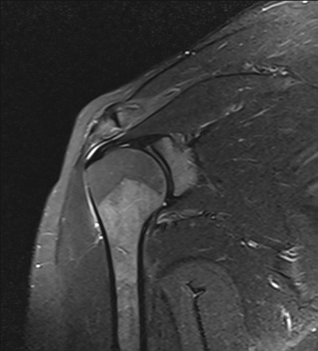 File:Calcific tendinitis of the infraspinatus tendon (Radiopaedia 87256-103537 Coronal PD fat sat 11).jpg