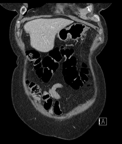 Calcified adrenal glands and Spigelian hernia (Radiopaedia 49741-54988 B 20).jpg