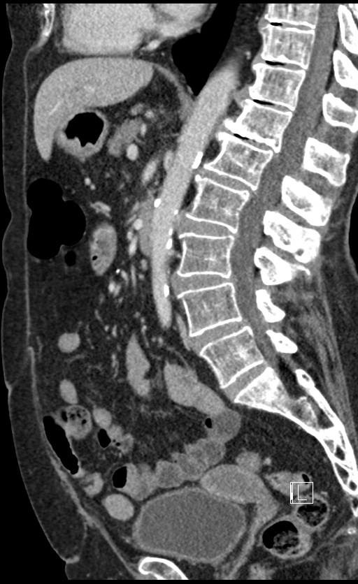 Calcified adrenal glands and Spigelian hernia (Radiopaedia 49741-54988 C 82).jpg