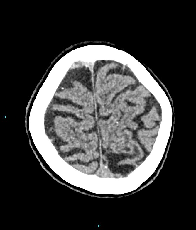 Calcified cerebral emboli from left ventricular thrombus (Radiopaedia 84420-99758 Axial non-contrast 18).jpg
