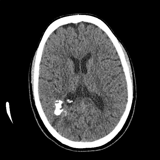 File:Calcified cerebral hydatid cyst (Radiopaedia 65603-74717 Axial non-contrast 41).jpg