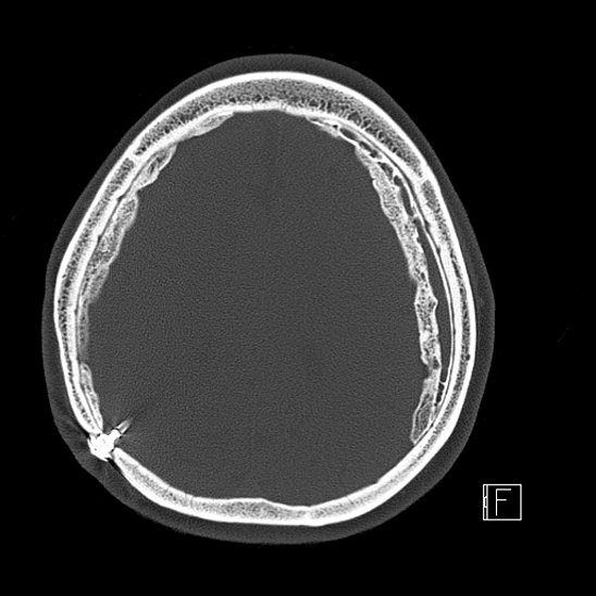 Calcified chronic subdural hematoma (Radiopaedia 77374-89492 Axial bone window 97).jpg
