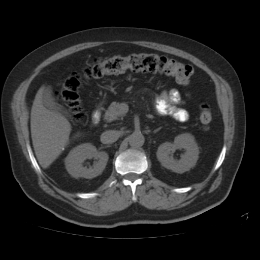 File:Calcified hepatic hydatid cyst (Radiopaedia 18907-18853 Axial non-contrast 22).jpg