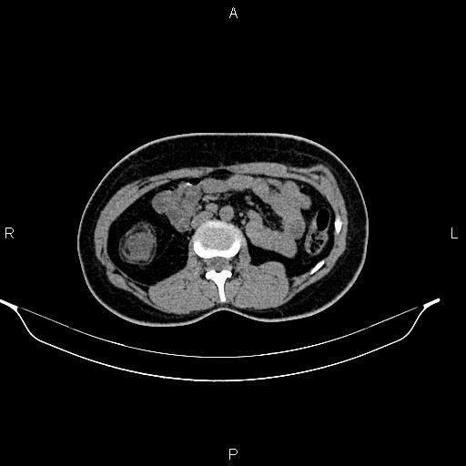 File:Calcified hepatic hydatid cyst (Radiopaedia 84672-100095 Axial non-contrast 50).jpg