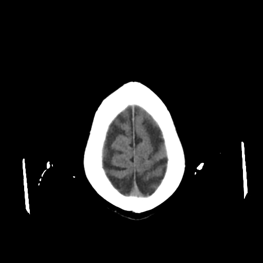 File:Calcified meningioma - cervical canal (Radiopaedia 70136-80171 Axial non-contrast 24).jpg
