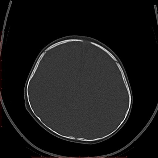 Calcified middle cerebral artery embolism (Radiopaedia 78949-91860 Axial bone window 55).jpg