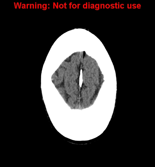 File:Calvarial thickening from chronic shunting (Radiopaedia 60079-67637 Axial non-contrast 27).jpg
