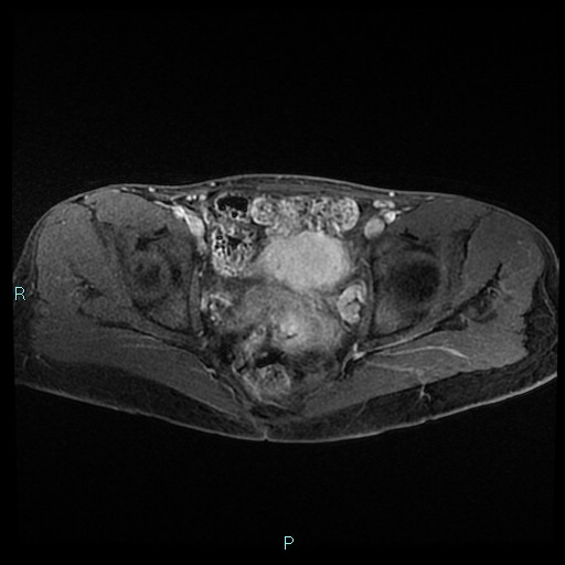File:Canal of Nuck cyst (Radiopaedia 55074-61448 Axial T1 C+ fat sat 35).jpg