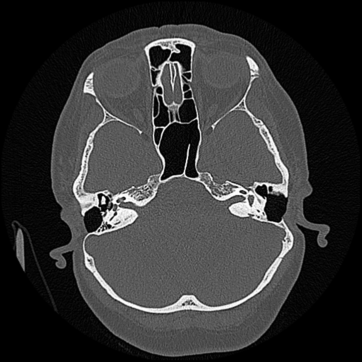 Canal up mastoidectomy (Radiopaedia 78108-90638 Axial bone window 78).jpg