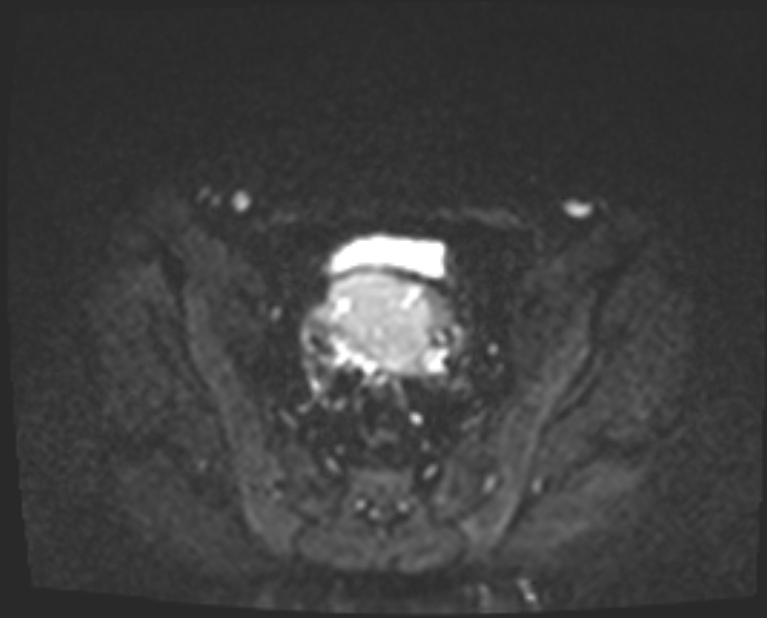 Cancer cervix - stage IIb (Radiopaedia 75411-86615 Axial DWI 19).jpg