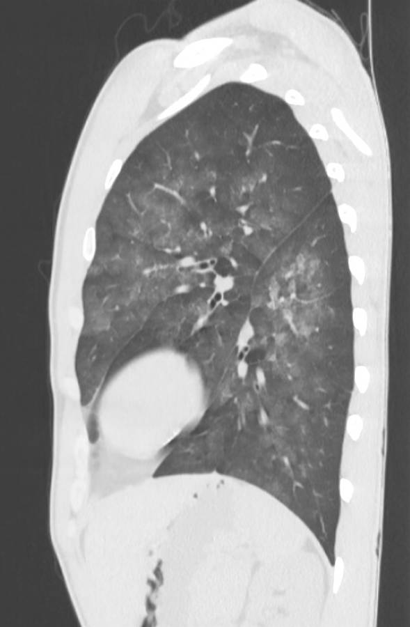 Cannabis-induced diffuse alveolar hemorrhage (Radiopaedia 89834-106946 Sagittal lung window 103).jpg