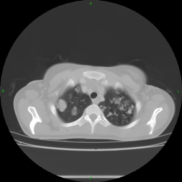 File:Cannon ball metastases - synovial sarcoma (Radiopaedia 26135-26271 Axial lung window 7).jpg