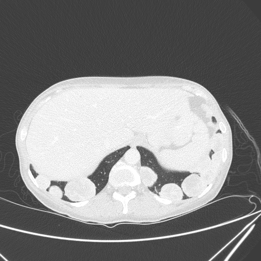 File:Canonball lung metastasis (Radiopaedia 77634-89837 Axial lung window 162).jpg