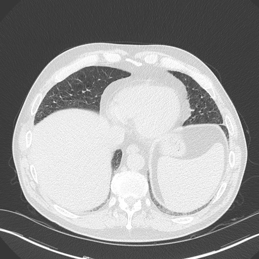Caplan syndrome (Radiopaedia 56667-63530 Axial lung window 153).jpg