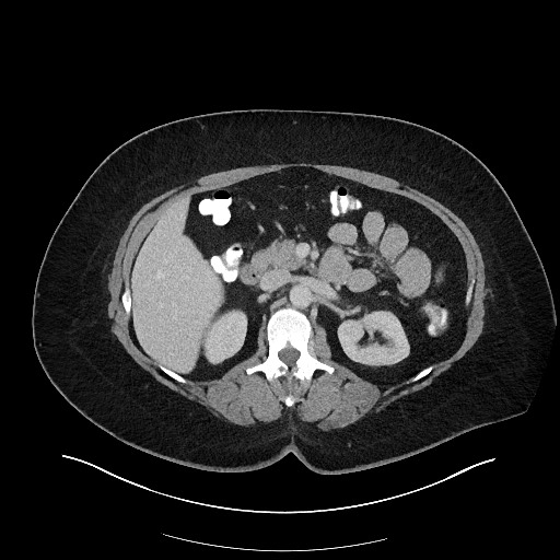 Carcinoid tumor - terminal ileum (Radiopaedia 60931-68739 A 49).jpg