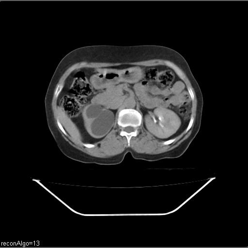 File:Carcinoma cervix- recurrence (Radiopaedia 34702-36137 B 69).jpg