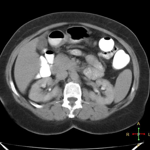 File:Carcinoma of sigmoid colon (Radiopaedia 23071-23100 C+ delayed 8).jpg