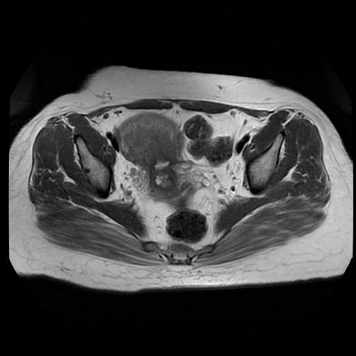 File:Carcinoma of the cervix (Radiopaedia 89018-105858 Axial T2 8).jpg
