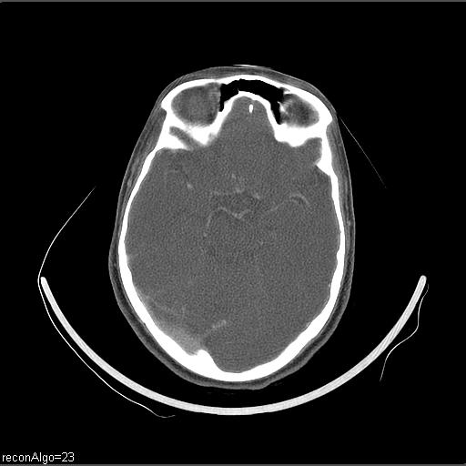 Carcinoma of the maxillary antrum (Radiopaedia 53805-59888 Axial C+ delayed 72).jpg
