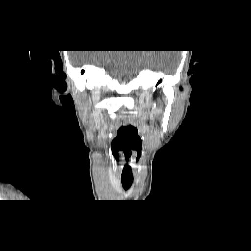Carcinoma of the maxillary antrum (Radiopaedia 53805-59888 Coronal C+ delayed 96).jpg