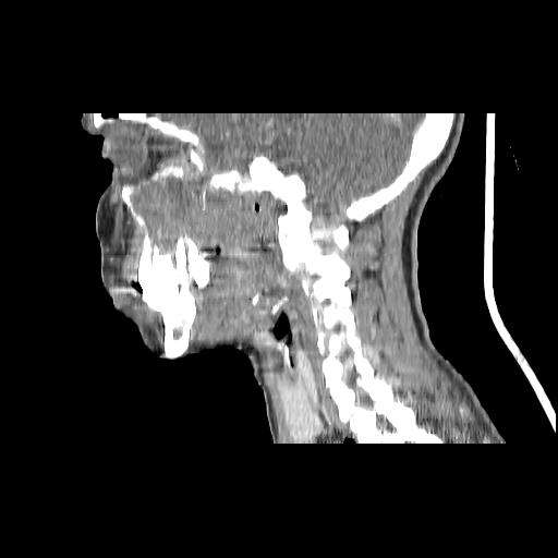 Carcinoma of the maxillary antrum (Radiopaedia 53805-59888 Sagittal C+ delayed 76).jpg