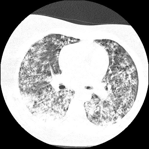Cardiac angiosarcoma (Radiopaedia 66010-75181 Axial lung window 51).jpg