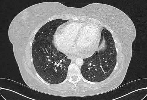 Cardiac sarcoidosis (Radiopaedia 74548-85534 Axial lung window 61).jpg