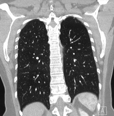 Cardiac sarcoidosis (Radiopaedia 74548-85534 Coronal lung window 52).jpg