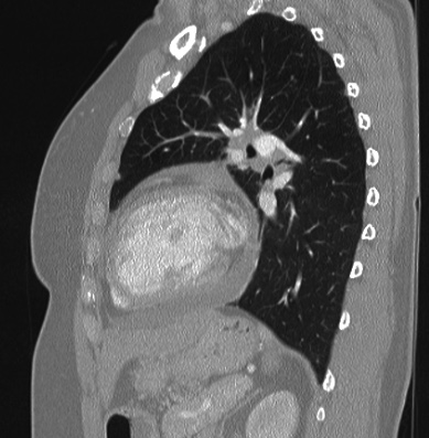 Cardiac sarcoidosis (Radiopaedia 74548-85534 Sagittal lung window 32).jpg