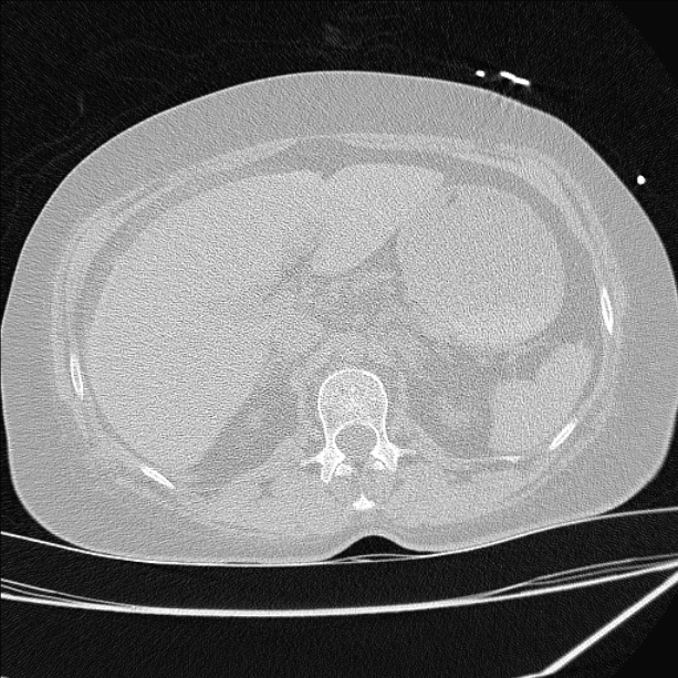 Cardiogenic pulmonary edema (Radiopaedia 29213-29609 Axial lung window 113).jpg