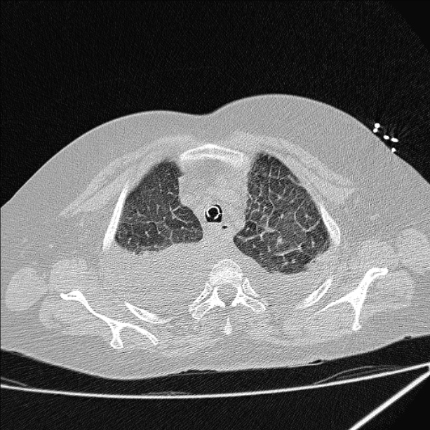 Cardiogenic pulmonary edema (Radiopaedia 29213-29609 Axial lung window 14).jpg