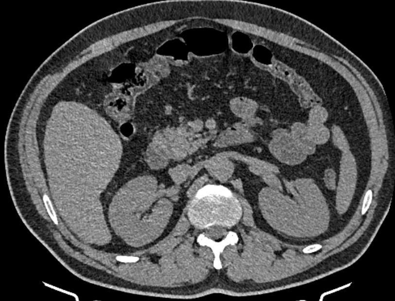Cardiogenic pulmonary edema (Radiopaedia 68180-77678 Axial non-contrast 74).jpg