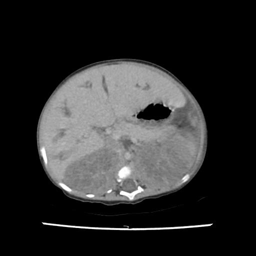 Caroli disease with autosomal recessive polycystic kidney disease (ARPKD) (Radiopaedia 89651-106703 B 76).jpg