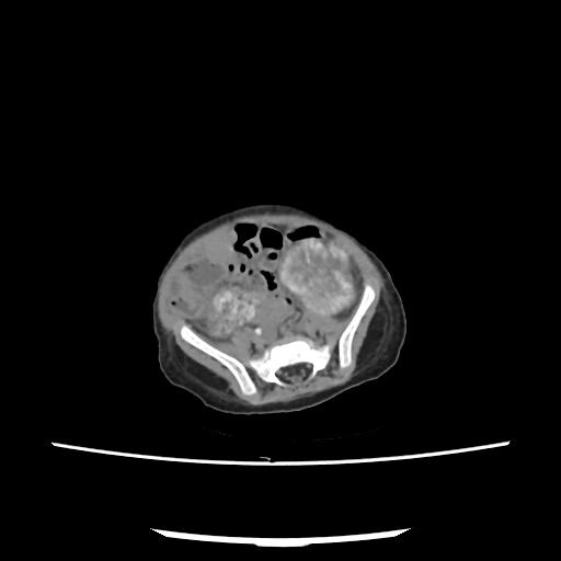 File:Caroli disease with autosomal recessive polycystic kidney disease (ARPKD) (Radiopaedia 89651-106703 E 180).jpg