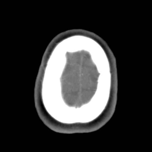 Carotico ophthalmic aneurysm (Radiopaedia 42916-46148 A 7).png