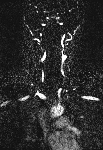 File:Carotid artery dissection (Radiopaedia 28441-28689 Coronal MRA 40).jpg