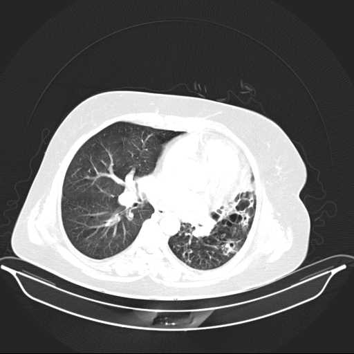 File:Carotid body tumor (Radiopaedia 21021-20948 Axial lung window 22).jpg