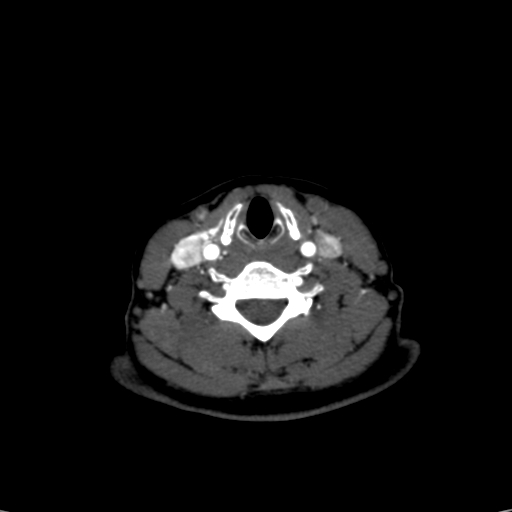 Carotid body tumor (Radiopaedia 39845-42300 B 8).jpg
