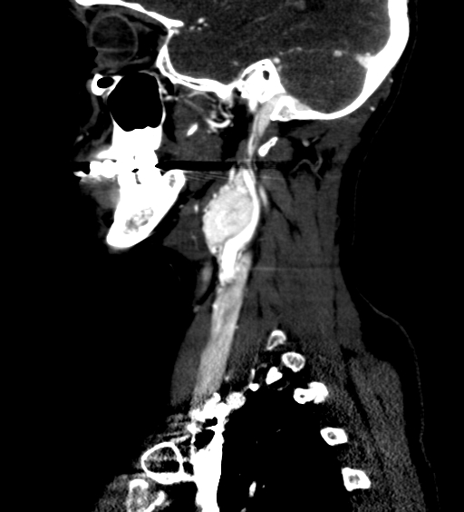 File:Carotid body tumor (Radiopaedia 39845-42300 D 25).jpg