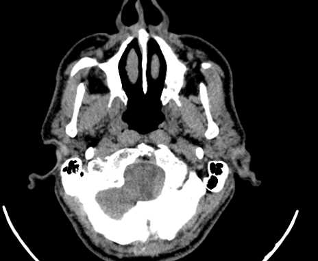 File:Carotid body tumor (Radiopaedia 61750-69757 Axial non-contrast 3).jpg